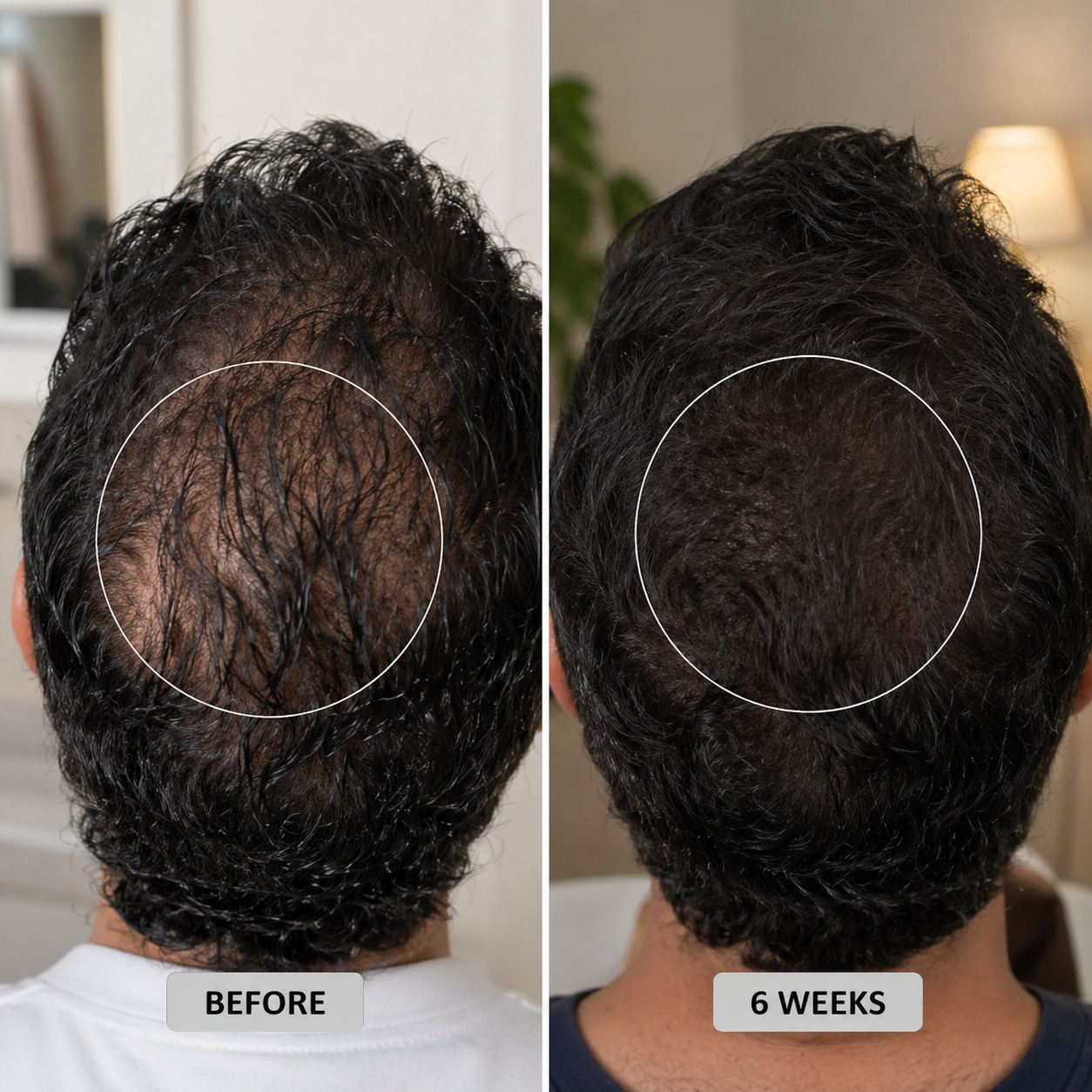 Therapy Cap for Hair Regrowth