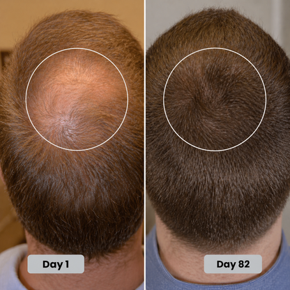 Therapy Cap for Hair Regrowth